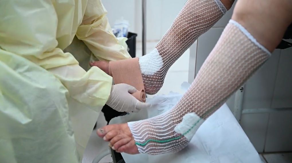 Na imagem há um profissional da saúde enfaixando o pé de uma pessoa que está sentada. A imagem só mostra as pernas da paciente que está com curativos.